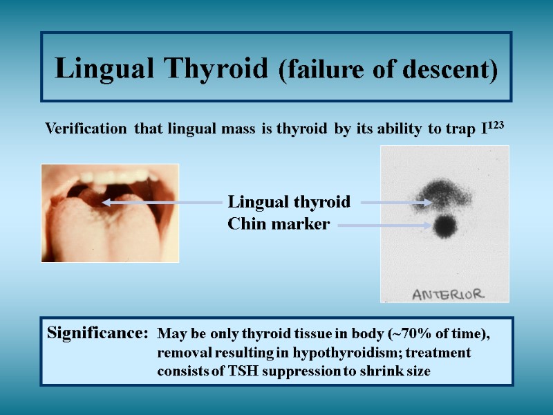 Lingual Thyroid (failure of descent) Verification that lingual mass is thyroid by its ability